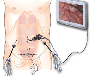 Λαπαροσκοπική χειρουργική