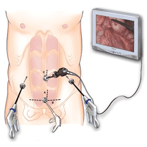 Λαπαροσκοπική χειρουργική