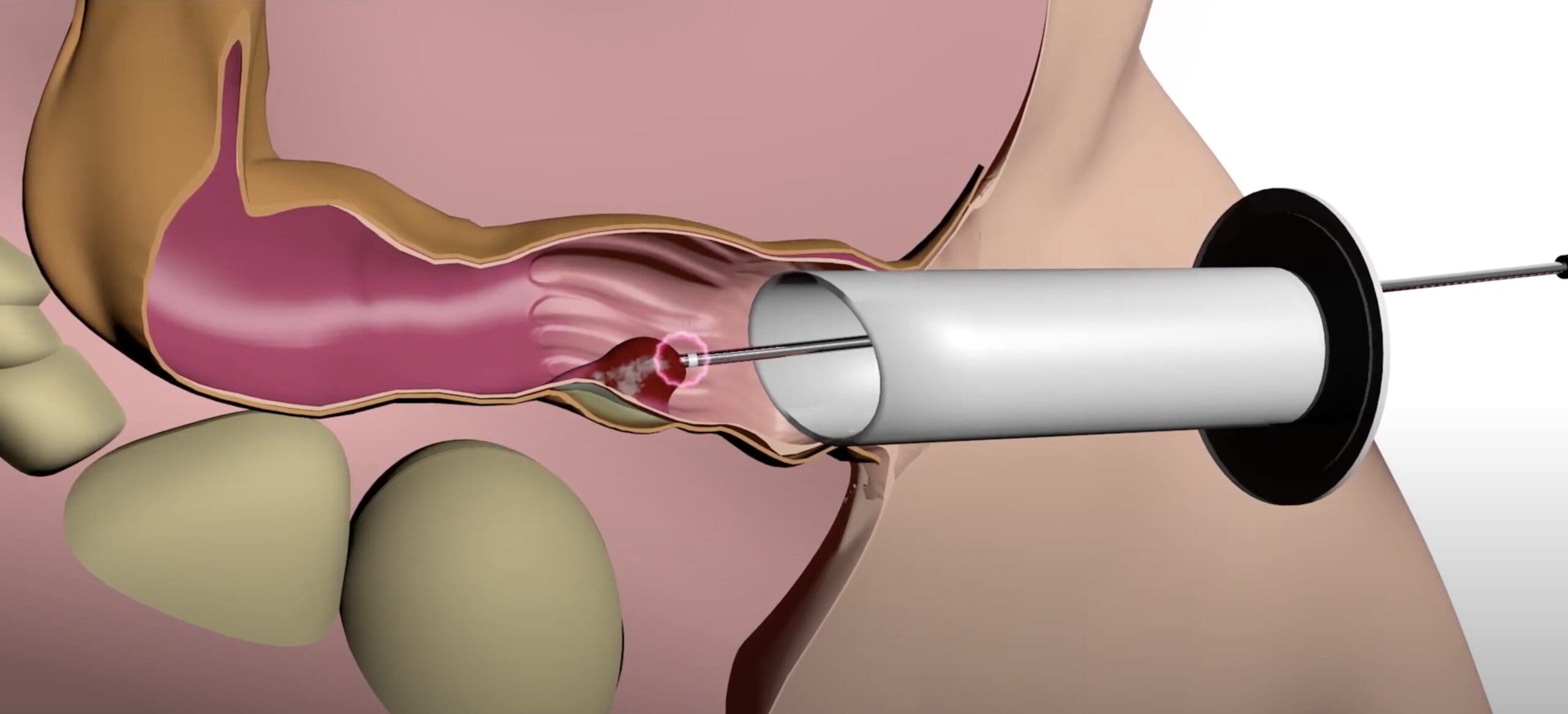 Η χρήση των ραδιοσυχνοτήτων (Μέθοδος Rafaelo®) στην αντιμετώπιση της αιμορροϊδοπάθειας